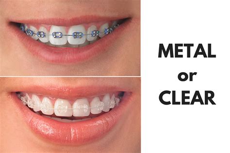 clear vs metal brackets|invisible braces vs metal.